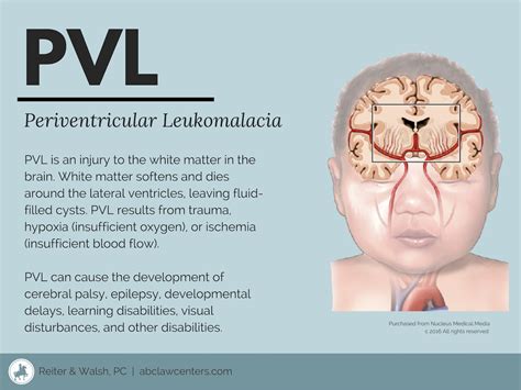 Periventricular Leukomalacia (PVL) and Birth Injury | Developmental delays, Injury, White matter