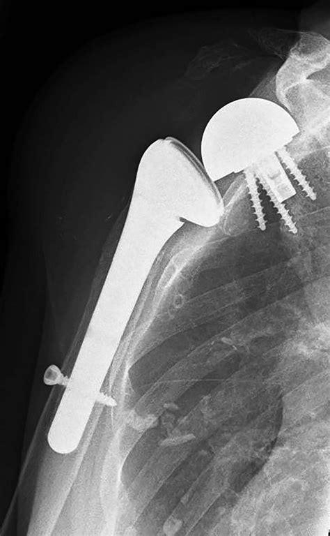 Prothese gut, alles gut? – the unhappy shoulder replacement ...