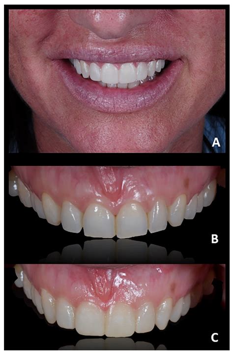 Prosthetically Guided Orthodontics (PGO): A Personalized Clinical ...