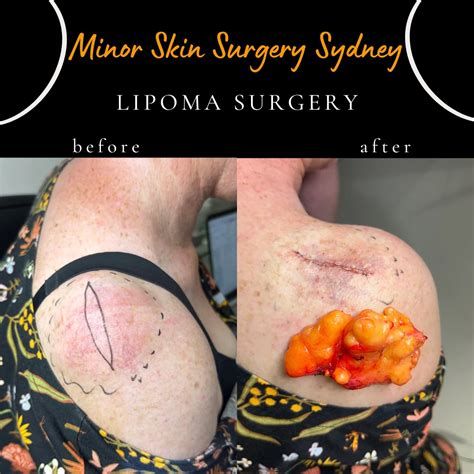Lipoma surgery, Treatment, Removal Sydney - Dr Peter Kim Surgery - Skin Cancer, Cosmetic & Laser ...
