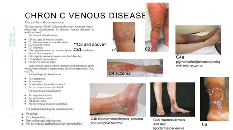 Venous disorders of the lower limbs, general surgery | PPTX