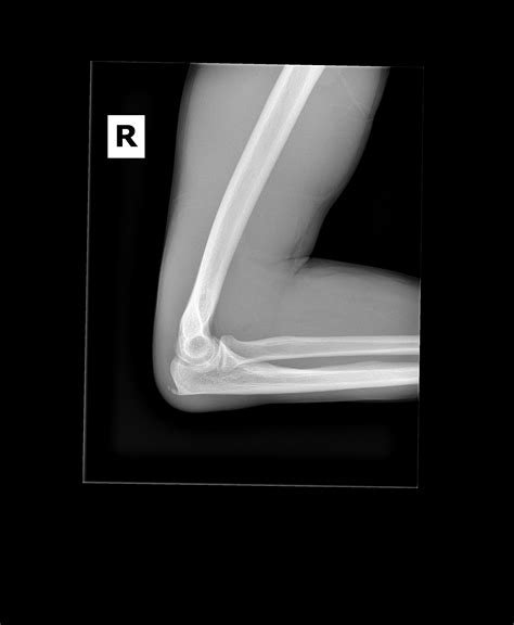 Doctor said "there is a posterior olecranon spur present with linear lucency in 2 separate ...