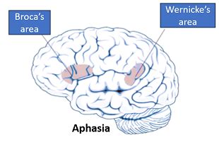 Image result for Aphasia Language Disorder