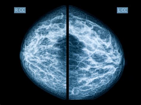 Abnormal Mammogram? 7 Questions to Ask Your Doctor | The Healthy