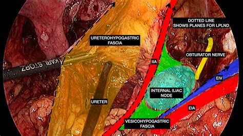 Laparoscopic Versus Robotic Lateral Pelvic Lymph Node Dissection in Locally‐Advanced Rectal ...
