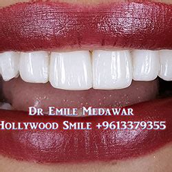Direct Veneers | Composite Veneers Lebanon