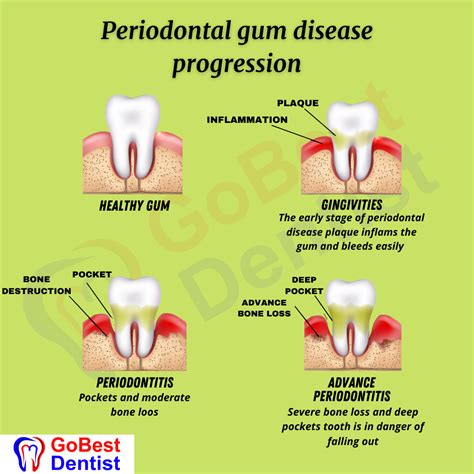 Flap Surgery & Gum Treatments - Gobest Dentist