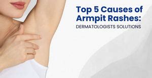 Top 5 Causes of Armpit Rashes: Dermatologists Solutions | Clinikally