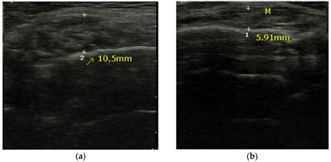 Masseter Muscle Thickness Measured by Ultrasound as a Possible Link ...