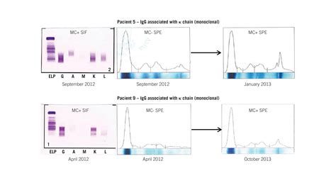Electrophoresis Multiple Myeloma
