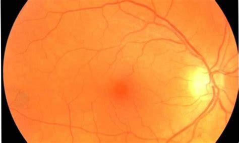 Smartphone-based cameras effective in screening for ocular diseases in ...