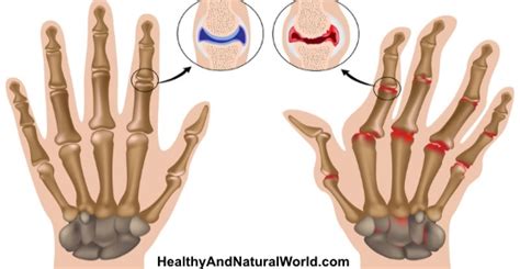 See What Happens When You Crack Your Knuckles