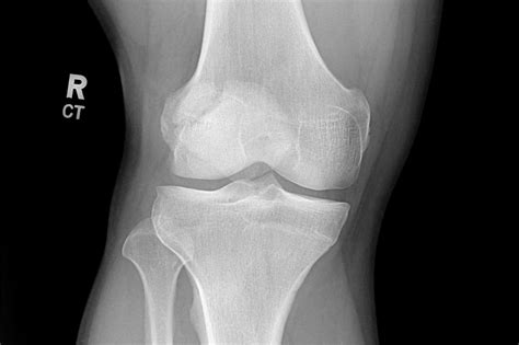 OrthoDx: Bipartite Patella - Clinical Advisor