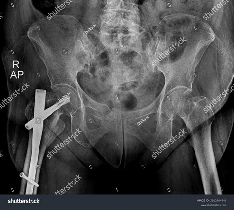 Open Reduction Internal Fixation Hip