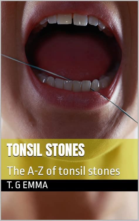 TONSIL STONES : The A-Z of tonsil stones eBook : Emma , T. G: Amazon.in ...