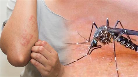 पंजाब के इस जिले में डेंगू का कहर, इतने नए रोगी मिले - dengue fever cases