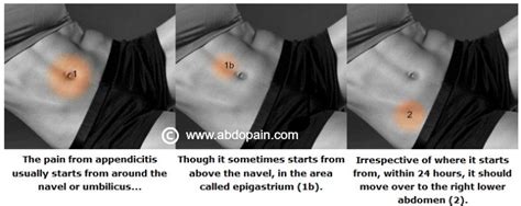Image result for Appendix Pain Area