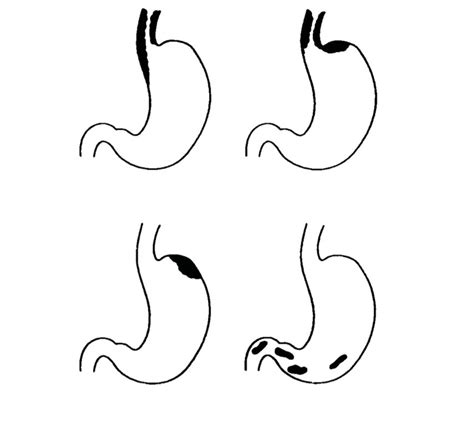 Ligatur? Kleben? TIPS? – Management von Ösophagus- und Fundusvarizen ...