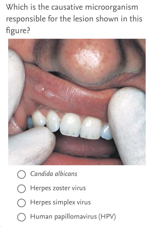 Solved: Which is the causative microorganism responsible for the lesion shown in this figure ...