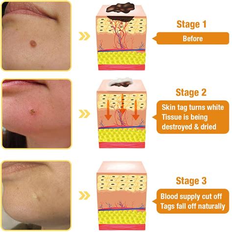 BSWell Bee Venom Skin Treatment Cream, 2024 New Bee Venom India | Ubuy