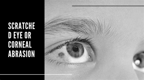 Eye injury | Causes of eye injury and tips to prevent them