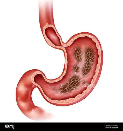 Gastritis Stomach Disease as an inflammation of the inner lining of the digestive organ with ...