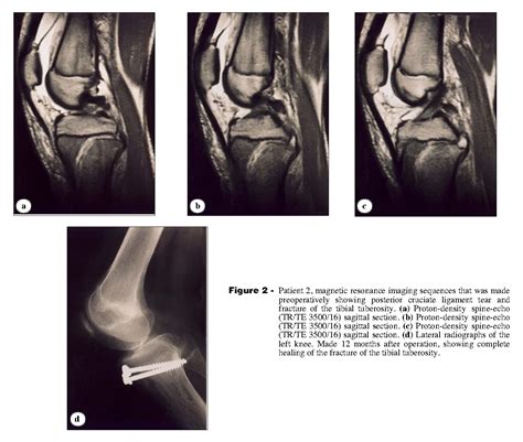 Figure 2 from Avulsion fractures of tibial tuberosity in adolescents. Treatment with closed ...
