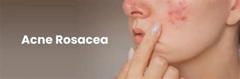Managing Acne Rosacea: Causes, Symptoms & Treatment Options