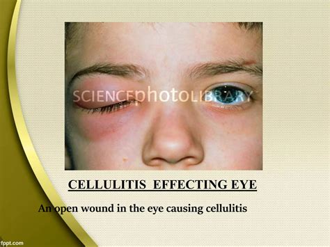 case study on cellulitis | PPT