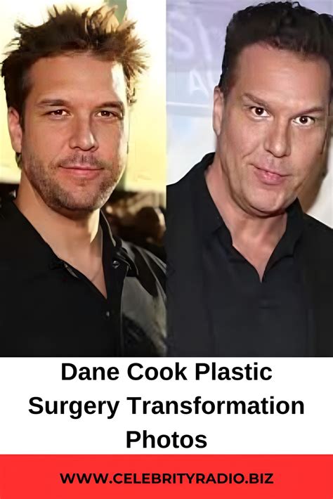 Dane Cook Face Surgery