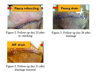 C-Section Wound 的图像结果