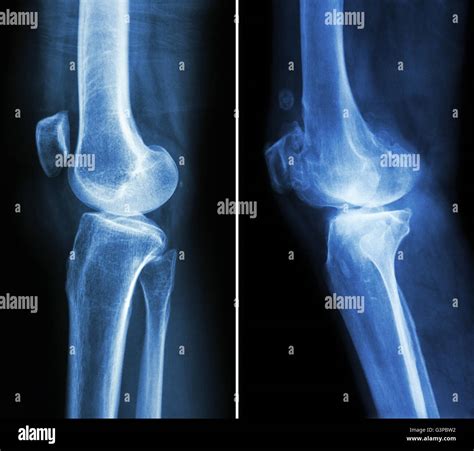 Normal knee x ray hi-res stock photography and images - Alamy