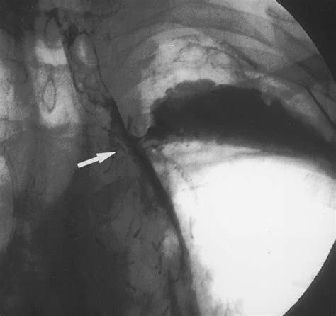 Symptomatic Malignant Gastroesophageal Anastomotic Leak Management with Covered Metallic ...