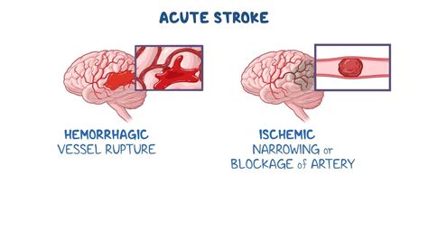 Video: Acute stroke (ischemic or hemorrhagic) or TIA: Clinical sciences | Osmosis