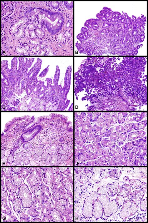 Intestinal metaplasia of the gastric cardia: findings in patients with versus without Barrett’s ...