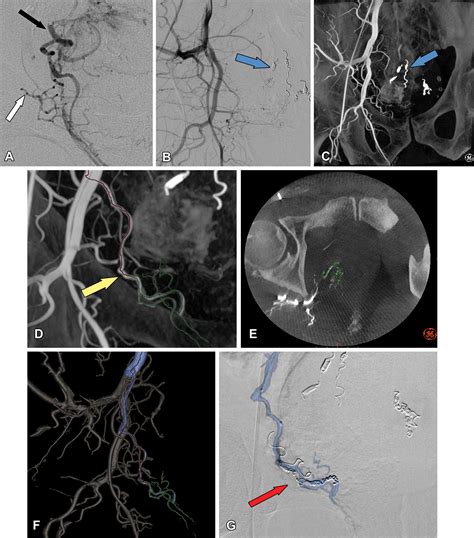 Rectal Artery Embolization for Hemorrhoidal Disease: Anatomy, Evaluation, and Treatment ...