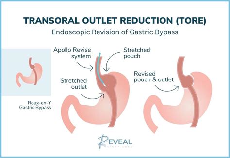 Gastric Bypass Revision (TORe) In Livingston, New Jersey