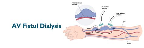 Fístula AV para diálisis: beneficios y complicaciones