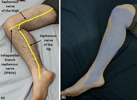 Ultrasound imaging of the femoral and saphenous nerves - Fenech - 2024 ...