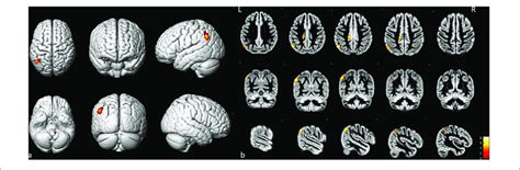 Image result for Contralateral Hemisphere