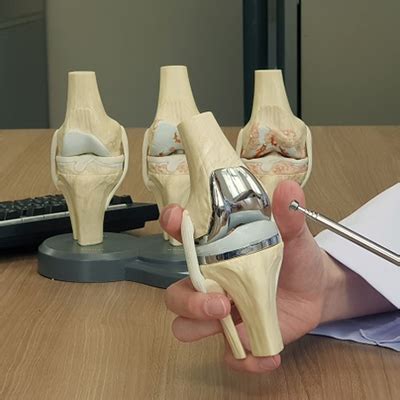 Knee Replacement Surgery in Guntur | Best Knee Replacement in Guntur ...