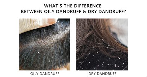 OILY Dandruff vs. DRY Dandruff: Causes, Differences, Symptoms Photos ...