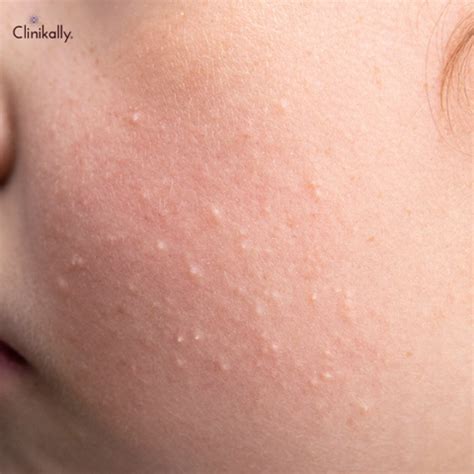 Milia (White Bumps) on Face: Causes & Treatment Plan | Clinikally