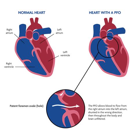 PFO Defect 的图像结果