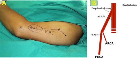 Image result for Contralateral Arm