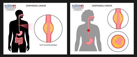 Symptoms of Esophagus Diseases | Gastro Esophageal Reflux Disease (GERD) - Kaizen Hospital