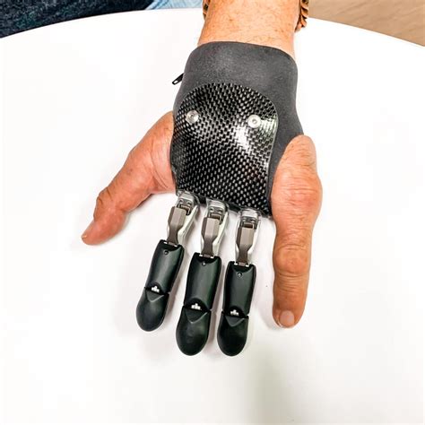 Finger Prostheses - All About Function | Westcoast Brace and Limb | Florida Orthotics and ...