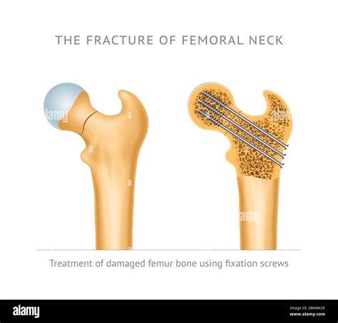 Femoral neck fracture hi-res stock photography and images - Alamy