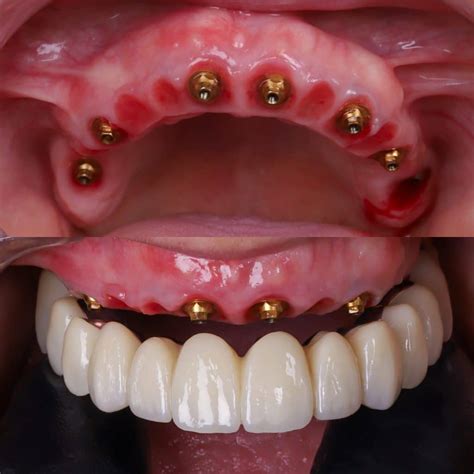 Complete dental implant price: everything you need to know