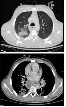 Streptococcus intermedius brain abscesses in an adolescent male with ...